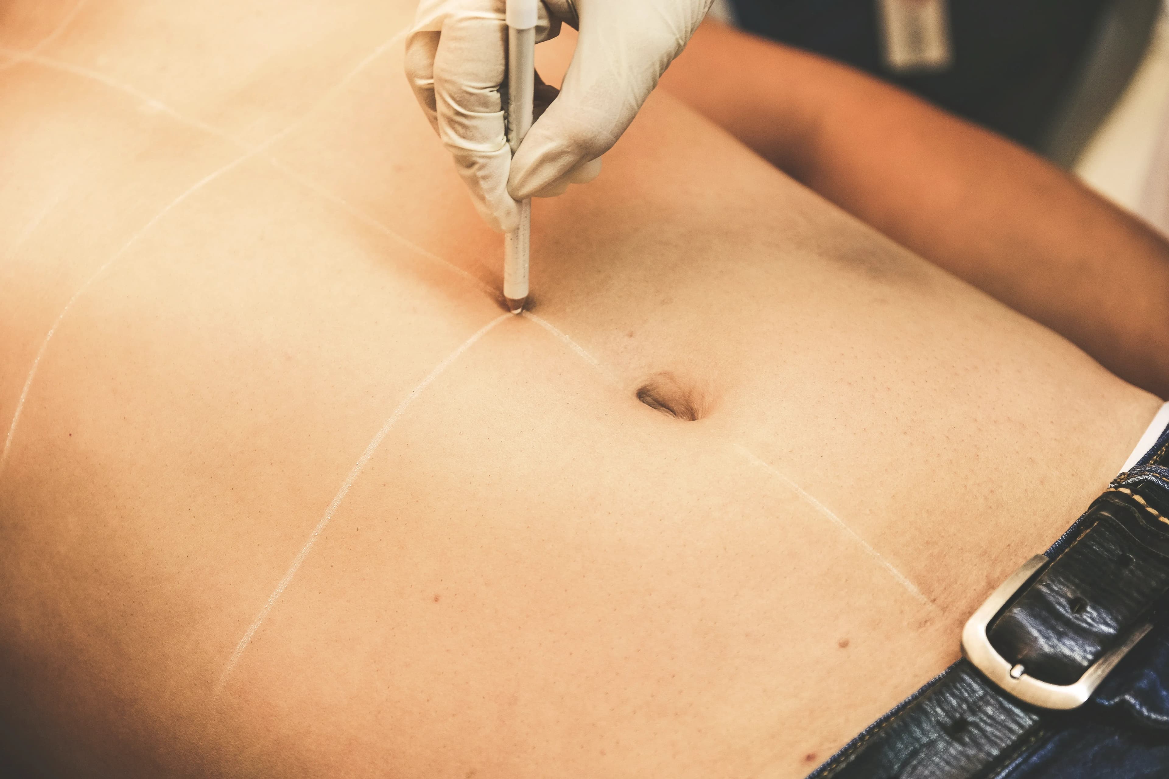 Liposuction